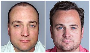 albuquerque hair transplant|Bosley Albuquerque .